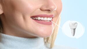 Dental Implants in the UK