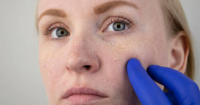 Pigmentation Treatment in Abu Dhabi
