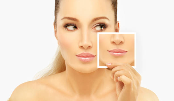 Russian lip fillers in Abu Dhabi