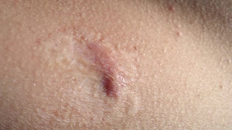 hypertrophic scar removal in Abu Dhabi