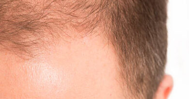 Sideburn Hair Transplant in Abu Dhabi